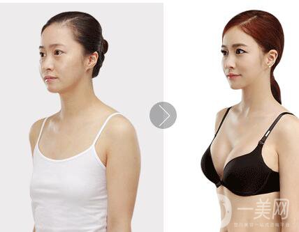 明星,隆胸,多少錢(qián)
