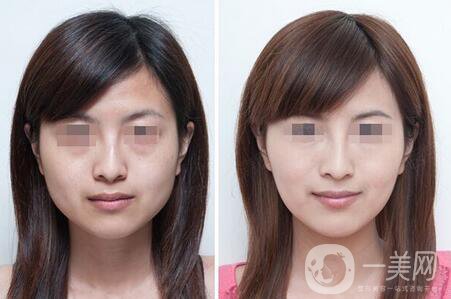 去頰脂墊*果 去頰脂墊*果與哪些因素有關