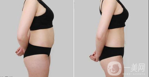 等離子激光溶脂價(jià)格 *果怎么樣？