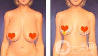 乳房下垂矯正方法介紹 乳房下垂矯正手術多少錢