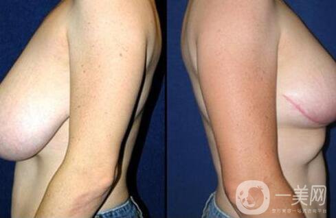乳房下垂矯正方法介紹 乳房下垂矯正手術多少錢