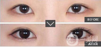 割雙眼皮,注意事項