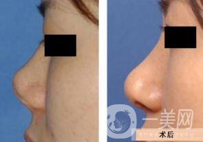 上海鼻小柱延長價(jià)格 鼻小柱延長手術(shù)多少錢