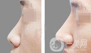 上海鼻小柱延長價(jià)格 鼻小柱延長手術(shù)多少錢