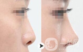 耳軟骨墊鼻尖術(shù)后護(hù)理 術(shù)后注意事項(xiàng)有哪些