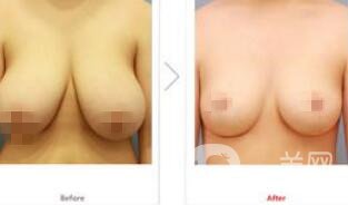 乳房縮小手術(shù)*嗎 乳房縮小有風(fēng)險(xiǎn)嗎