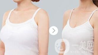 乳房縮小手術(shù)*嗎 乳房縮小有風(fēng)險(xiǎn)嗎