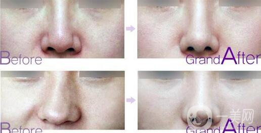 歪鼻矯正多少錢 歪鼻矯正價(jià)格盤點(diǎn)