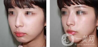 鷹鉤鼻矯正注意事項詳細介紹 鷹鉤鼻矯正如何護理