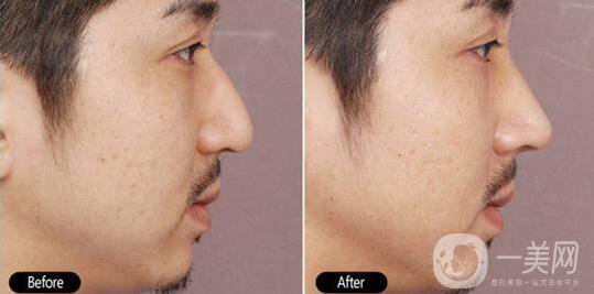 鷹鉤鼻矯正注意事項詳細介紹 鷹鉤鼻矯正如何護理