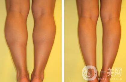 *瘦小腿多少錢(qián) *瘦小腿價(jià)格詳情