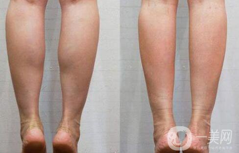 *瘦小腿多少錢(qián) *瘦小腿價(jià)格詳情