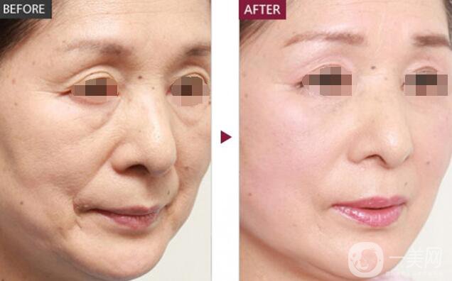 伊維蘭填充除皺價格 伊維蘭填充除皺多少錢