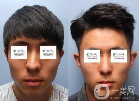 鼻歪矯正手術(shù)痛苦嗎？ 鼻歪矯正手術(shù)有多痛苦？