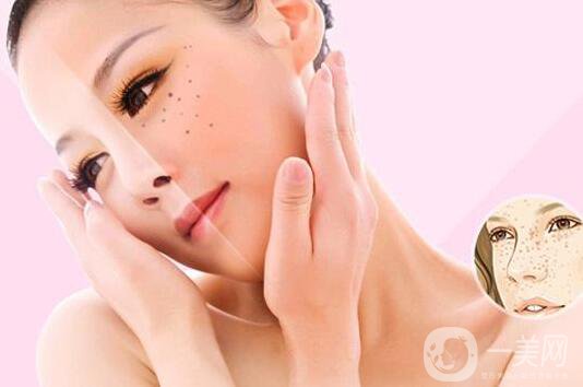 醫(yī)院祛斑價格 醫(yī)院祛斑要多少錢