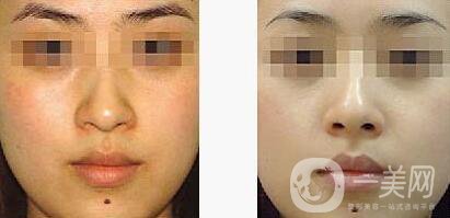 光子嫩膚的費用 光子嫩膚具體價格