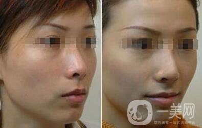 光子嫩膚的費用 光子嫩膚具體價格