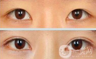 割雙眼皮疼不疼？打了麻藥還疼嗎？