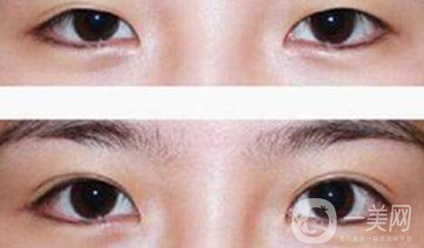 割雙眼皮疼不疼？打了麻藥還疼嗎？