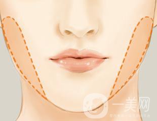 去頰脂墊多久恢復 與哪些因素有關？