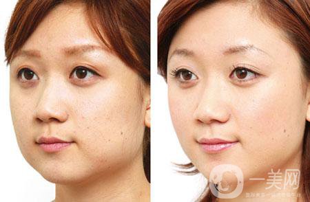 去頰脂墊多久恢復 與哪些因素有關？