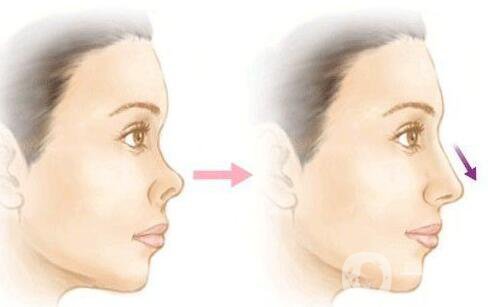 朝天鼻矯正注意事項 朝天鼻矯正如何護理