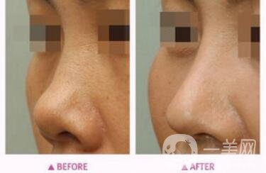 朝天鼻矯正注意事項 朝天鼻矯正如何護理