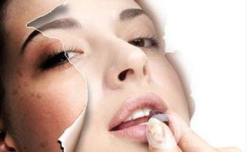 蝴蝶斑怎么去?價(jià)格一般是多少？