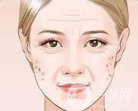 為什么會(huì)長老年斑，和哪些因素有關(guān)？