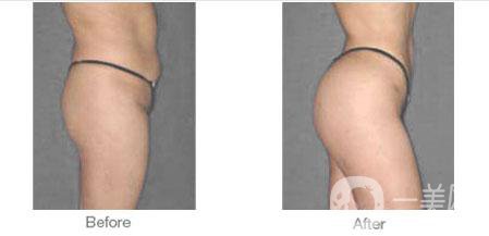 廣東豐臀手術(shù)多少錢 影響因素有哪些？