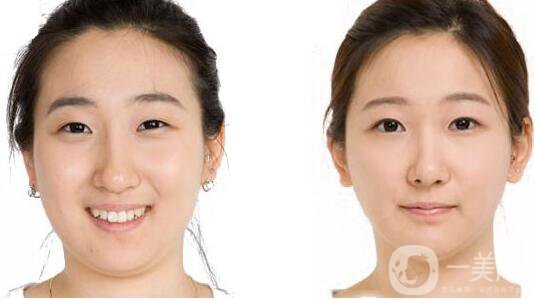 去頰脂墊,多少錢 