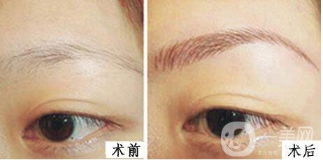 廣東,自體脂肪豐眉弓,費用