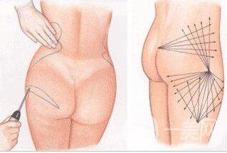 廣東,臀部抽脂,多少錢