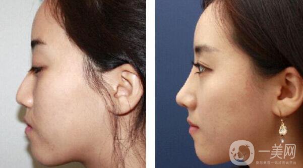 廣東,自體脂肪隆鼻,價(jià)格