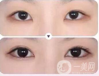 割雙眼皮