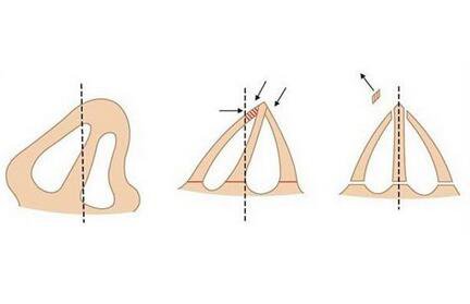 上海鼻梁骨矯正手術(shù)費用 價格盤點