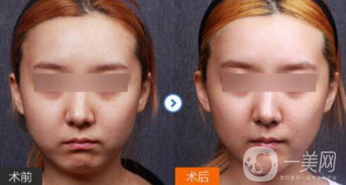 下巴做膨體還是硅膠好 *果怎么樣呢