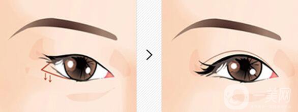 眼瞼下至多久后會回縮 眼瞼下至術后護理