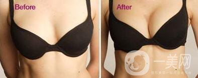 假體隆胸多久變得柔軟  多久徹底恢復(fù)