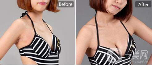 假體隆胸多久變得柔軟  多久徹底恢復(fù)