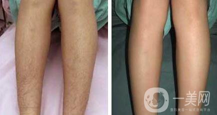 半導(dǎo)體激光脫毛價格介紹 脫毛前后照片