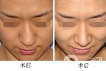 歪鼻矯正的危害 歪鼻矯正術(shù)后護(hù)理詳細(xì)介紹