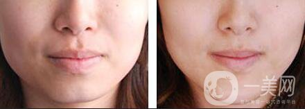 墊下巴用什么材料好 墊下巴要多少錢