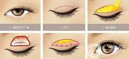 上瞼提肌后是*的嗎 上瞼提肌可以保持多久