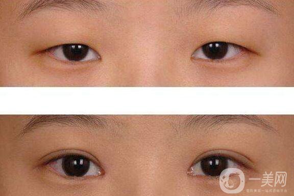 上瞼提肌后是*的嗎 上瞼提肌可以保持多久