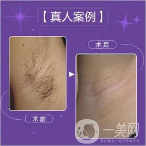 激光脫毛多少錢一次比較合理？