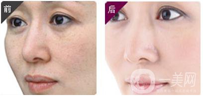 黑臉娃娃做一次多少錢 正規(guī)醫(yī)院收費多少錢？