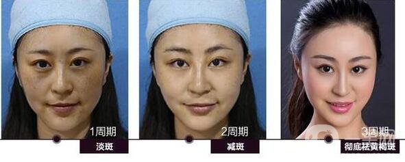 調(diào)節(jié)黃褐斑,多少錢
