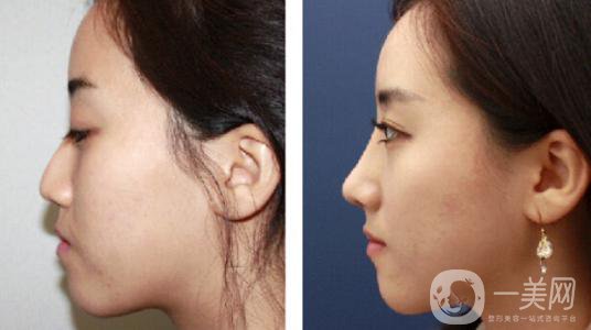 *術(shù)后要忌口嗎？術(shù)后注意事項有哪些？