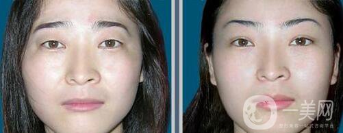 廣東眉整形價(jià)格多少 眉整形要多少錢